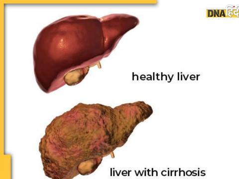 Liver Cirrhosis 7 Symptoms