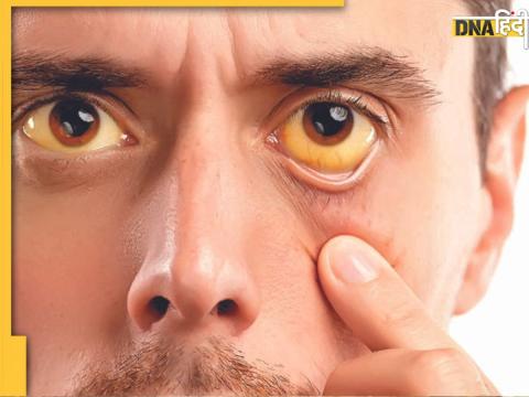 Causes of yellow eyes