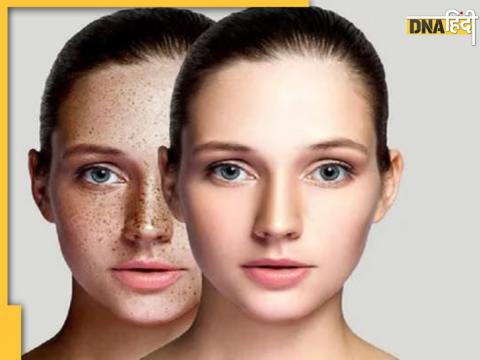 Dark Spots Causes