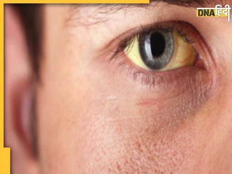 Jaundice Home Remedies