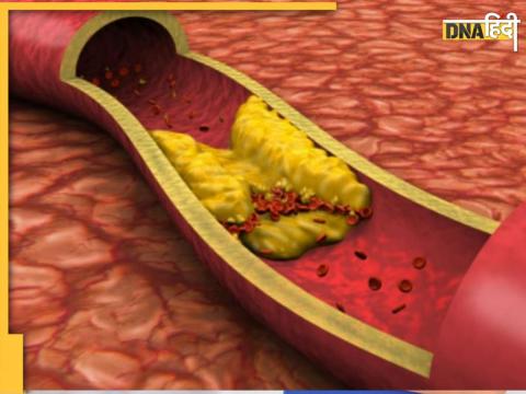 5 Mistakes Raise High Cholesterol