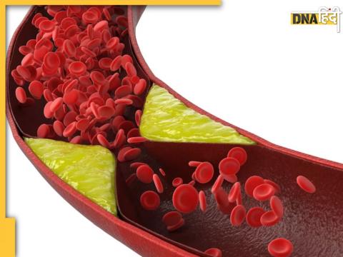 Cholesterol Treatment: