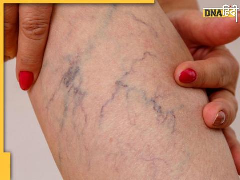 Leg Pain Causes Varicose Veins