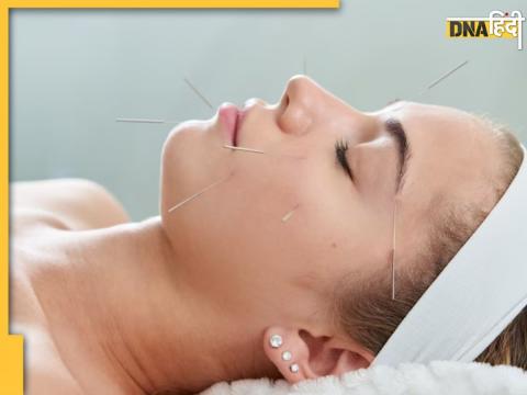 Acupuncture Therapy Benefits