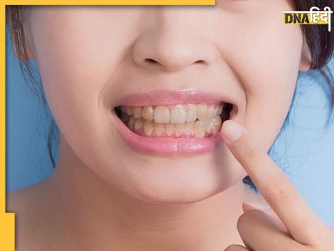 Remedies For Yellow Teeth