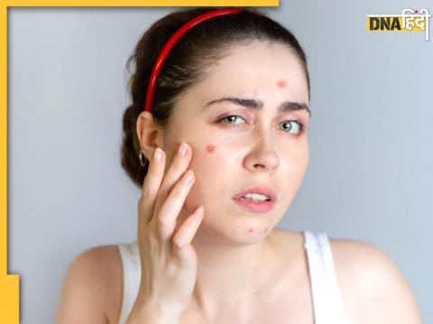 Remedies For Removing Pimples