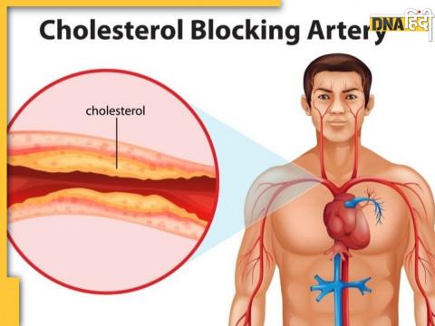 Bad Cholesterol Causes 