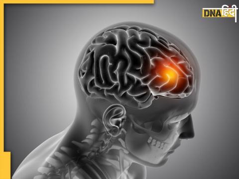 Brain Stroke Risk