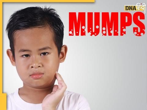 Mumps Virus Attack