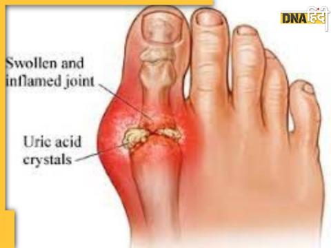  Arthritis- Gout Sign