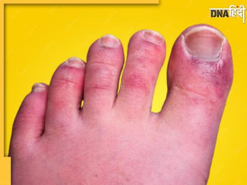 Chilblains Symptoms