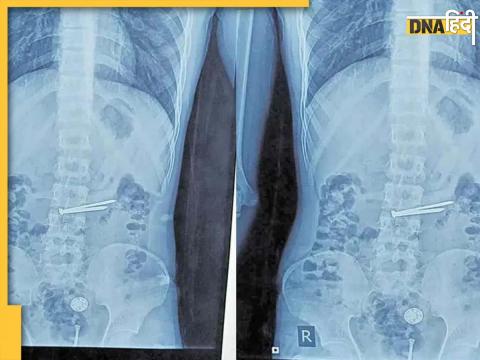 X-Ray Image of Stomach