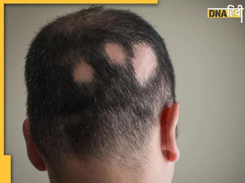 Alopecia Areata Symptoms