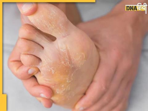 Foot Fungal Infection Remedy