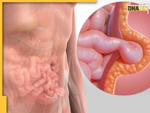 Hernia Symptoms