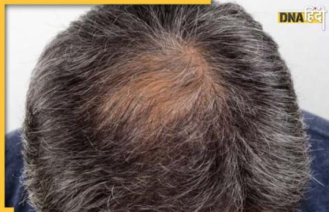 Hair Loss Treatment