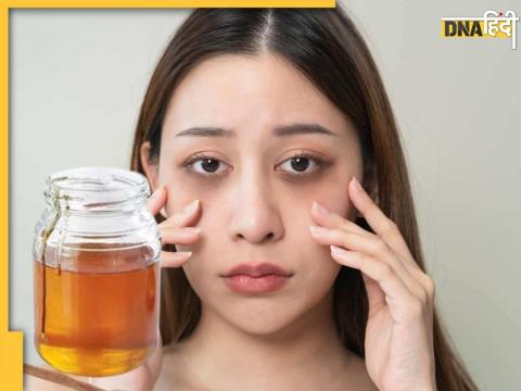 Dark Circles Remedies