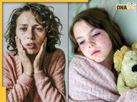 Measles Outbreak Measles Outbreak