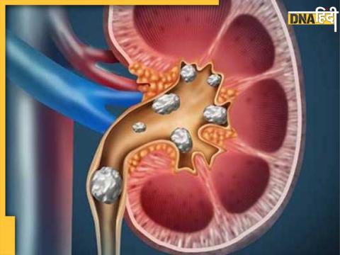 kidney stone symptoms 