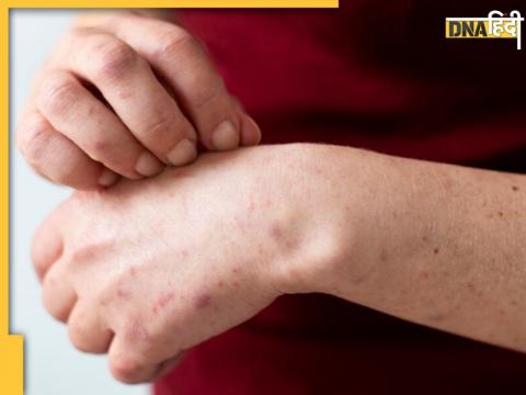 नसों पर ऐसे हमला करता है Shingles का वायरस