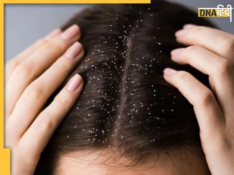 Remedies For Dandruff Removal