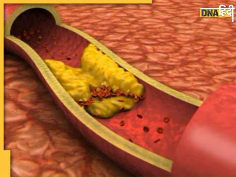 इन तरीकों से कम होगा नसों में फंसा गंदा कोलेस्ट्रॉल