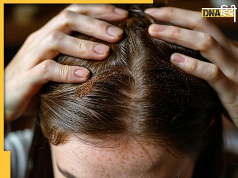 Home Remedies To Stop Hair Loss