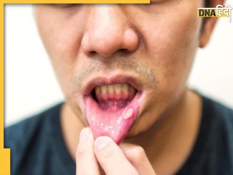 Mouth Ulcers