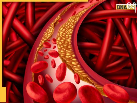 loss of high cholesterol