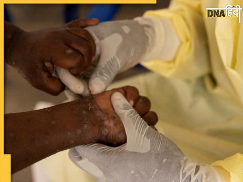 india prepares for mpox threat hospital airports alerted 