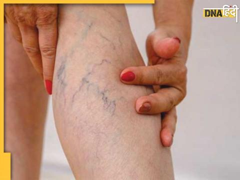 Varicose Veins