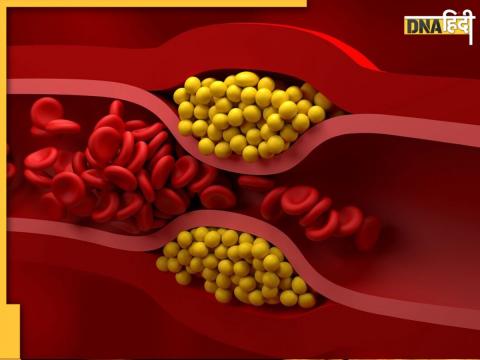 LDL Cholesterol symptoms on Face