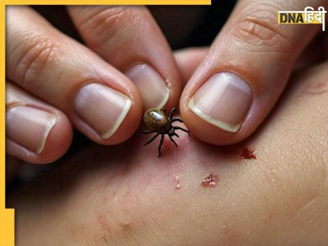 Tick Borne Virus