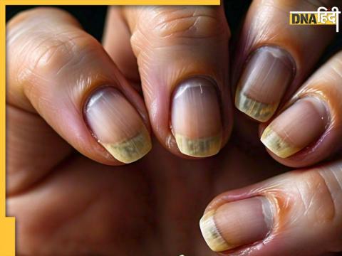 Nails Health Indication