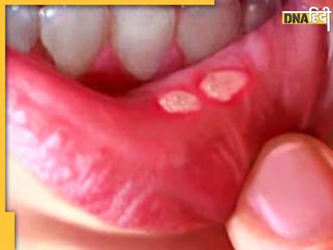 Mouth Ulcer Home Remedies