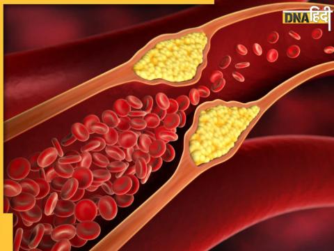 cholesterol remedies