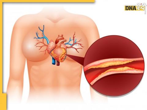 Cholesterol Remedy