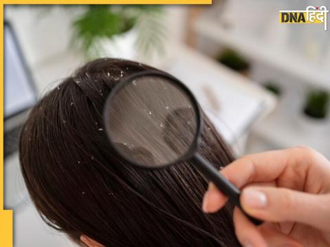 Dandruff Home Remedies