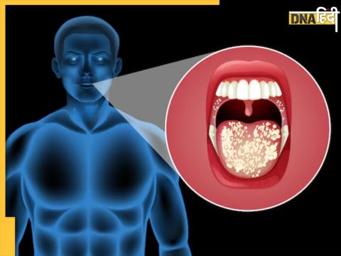 15 early symptoms of mouth cancer 