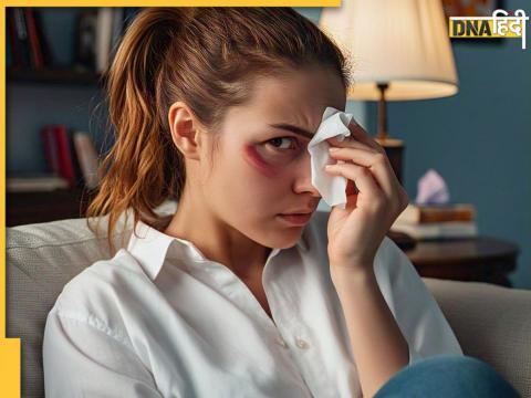 conjunctivitis