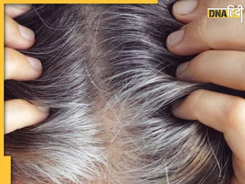White Hair Remedies White Hair Remedies