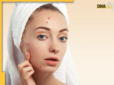 Pimples Remedies Pimples Remedies