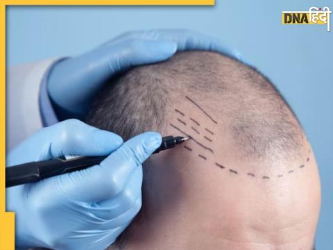 सांकेतिक तस्वीर hair transplant