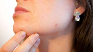 Skin problem: What are the 6 different types of acne?