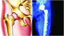 World Osteoporosis Day: Meaning, symptoms, treatment