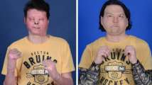 In a first, man receives successful face and hand transplant