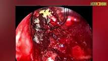Yellow fungus infection: Here is all you need to know