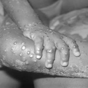 What are the symptoms and treatment of monkeypox, a deadly infection spreading among humans - Vimarsana News