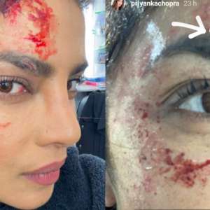 Priyanka Chopra hurts herself on the sets of 'Citadel', take a look at the photo - Vimarsana News