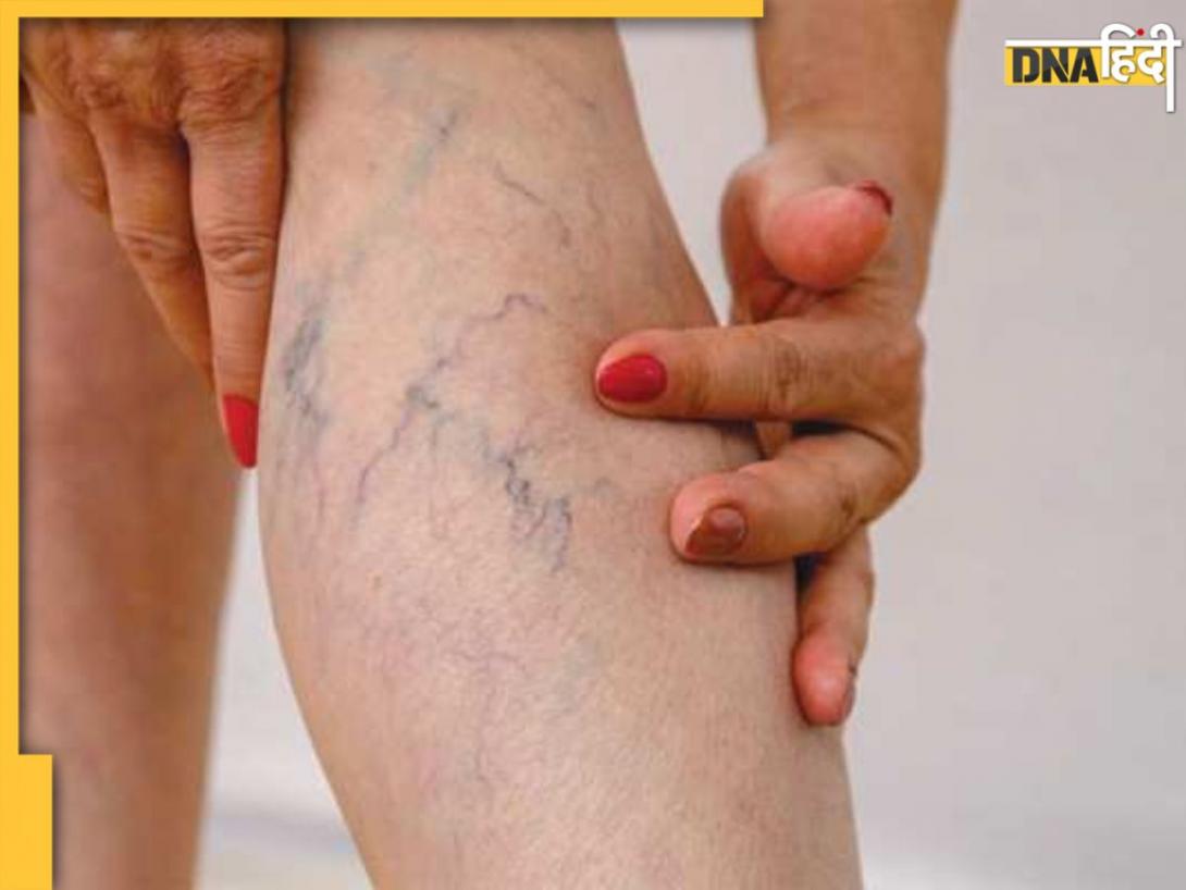 पैरों में नजर आ रही हैं नीली नसें तो हो गई है Varicose Veins की समस्या, इन 4 एक्सरसाइज से करें दूर